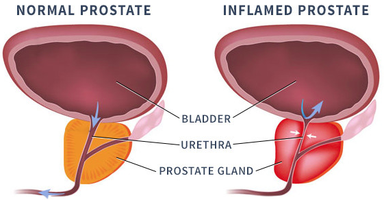 Go for Prostate Test Once you begin to notice these signs