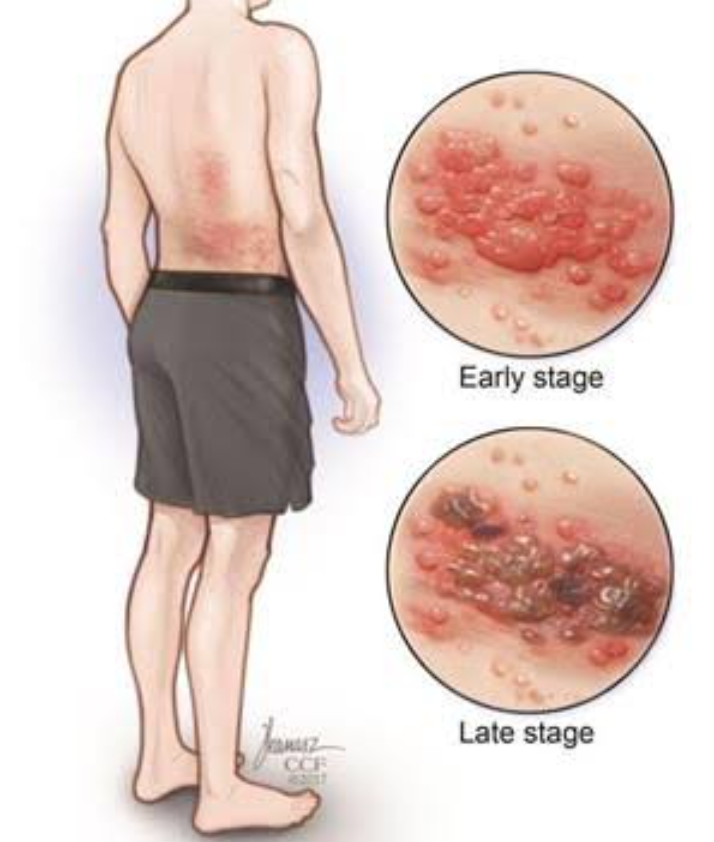 Shingles: Forms, symptoms, diagnosis and treatment