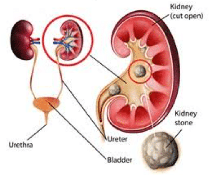 Kidney Stone Disease Explained, Foods to avoid