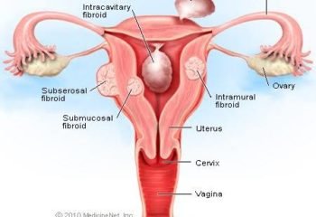 Fibroids, Pregnancy and Fertility: What to Know?