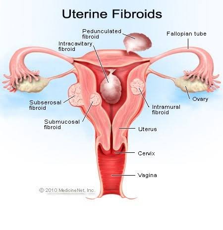 Fibroids, Pregnancy and Fertility: What to Know?