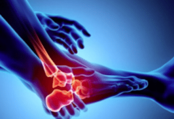 Arthritis: types, symptoms and treatment