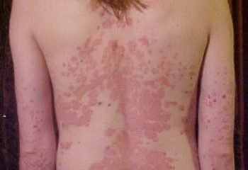 Psoriasis: All you need to know about it