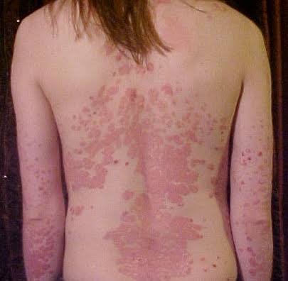 Psoriasis: All you need to know about it