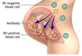 Rhesus Factor Challenges in Child Delivery