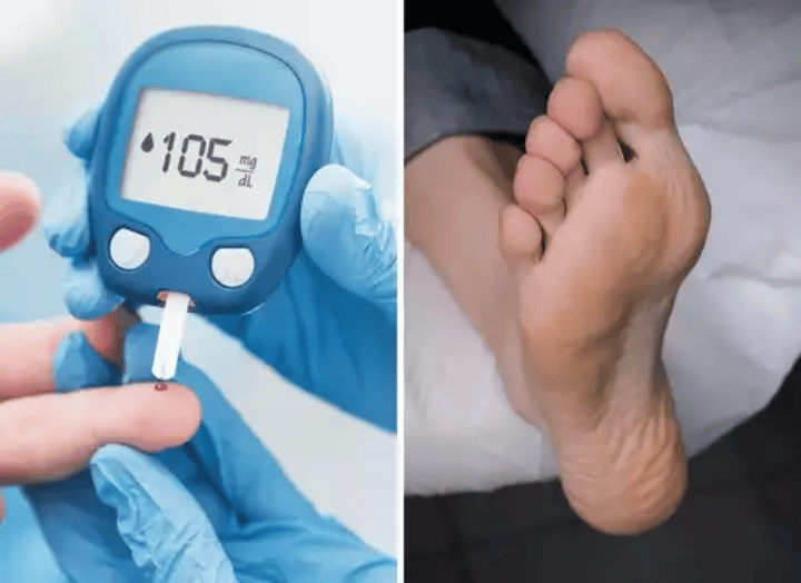 Diabetes In Your Feet: Seven Signs That Indicate High Blood Sugar Levels