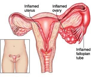 Everything you need to know about Pelvic Inflammatory Disease