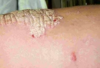 10 things you need to know about Psoriasis
