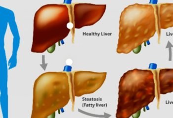 Everything to know about fatty liver disease