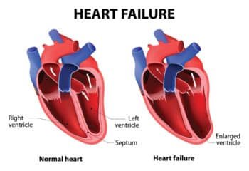 Everything To Know About Heart Failure