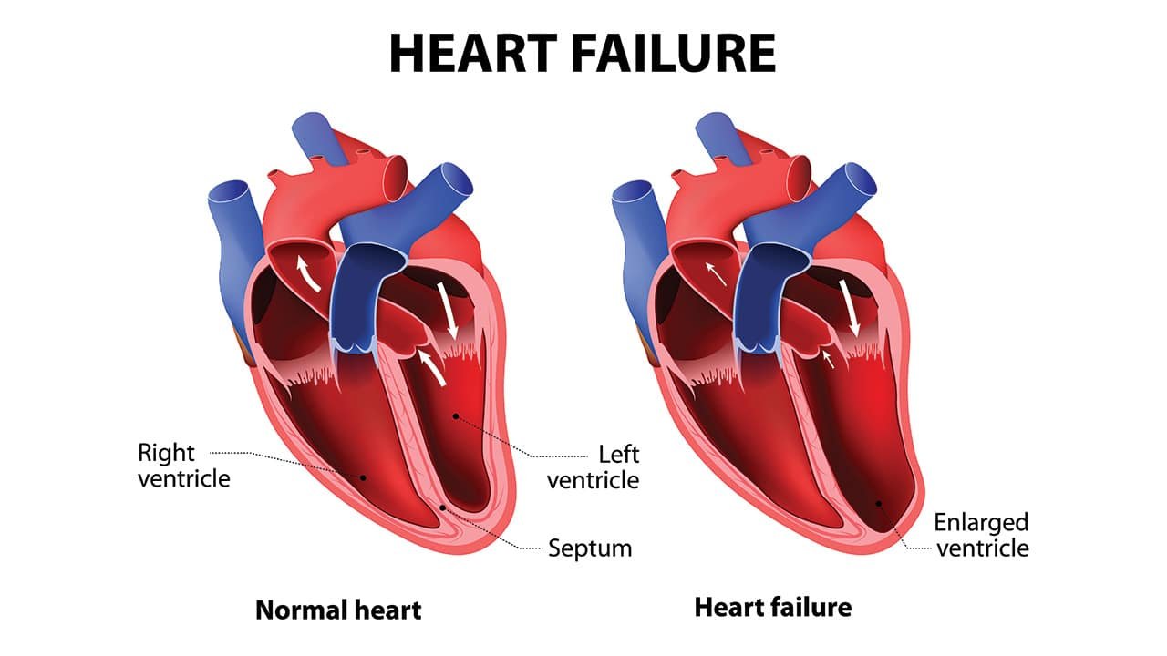 Everything To Know About Heart Failure