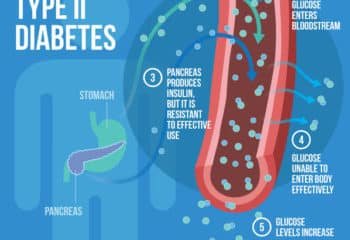 Every Important Fact to Know About Type 2 Diabetes