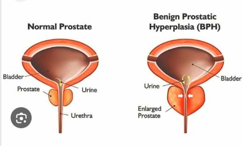 Unhealthy Habits That Lead To Prostate Problems In Men