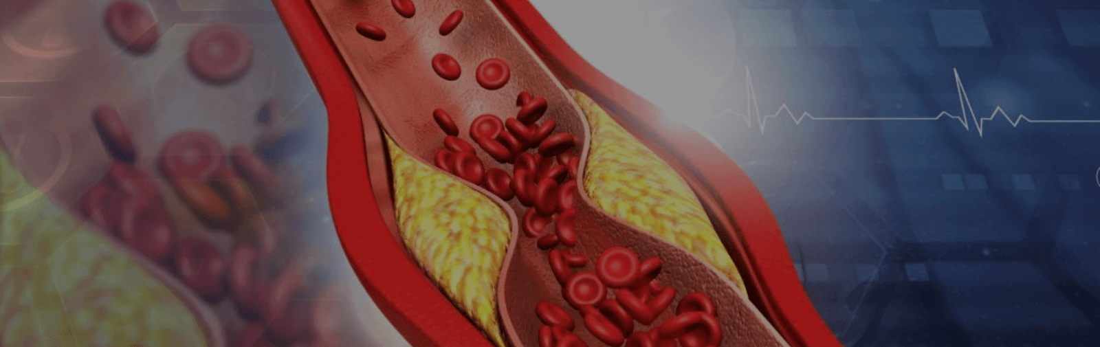 Everything to know about Arteriosclerosis and Atherosclerosis