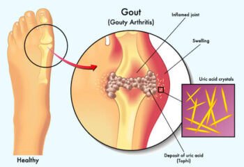 How to regulate uric acid level: foods to avoid