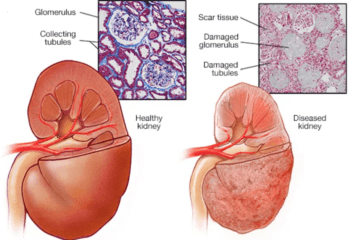 Everything To Know About Diabetic Nephropathy