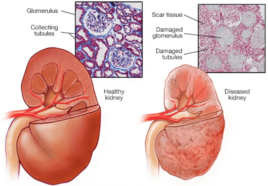 Everything To Know About Diabetic Nephropathy