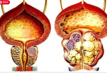 Everything To Know About Prostatitis