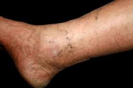 Rheumatism, Varicose Veins