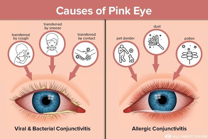 Redness of the eye