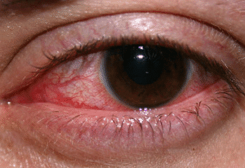 Herbal Recipes for Redness of the Eye