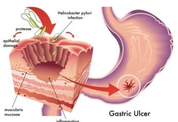 Everthing To Know About Helicobacter Pylori
