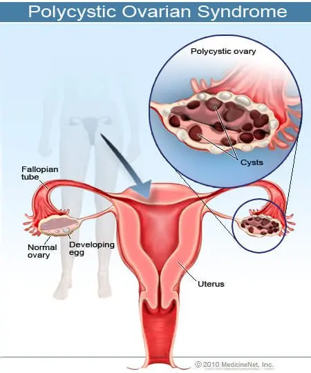 2011_pcos