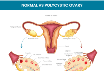 PCOS Is Now PMOS: Doctors Say Name Change Will Improve Diagnosis, Care