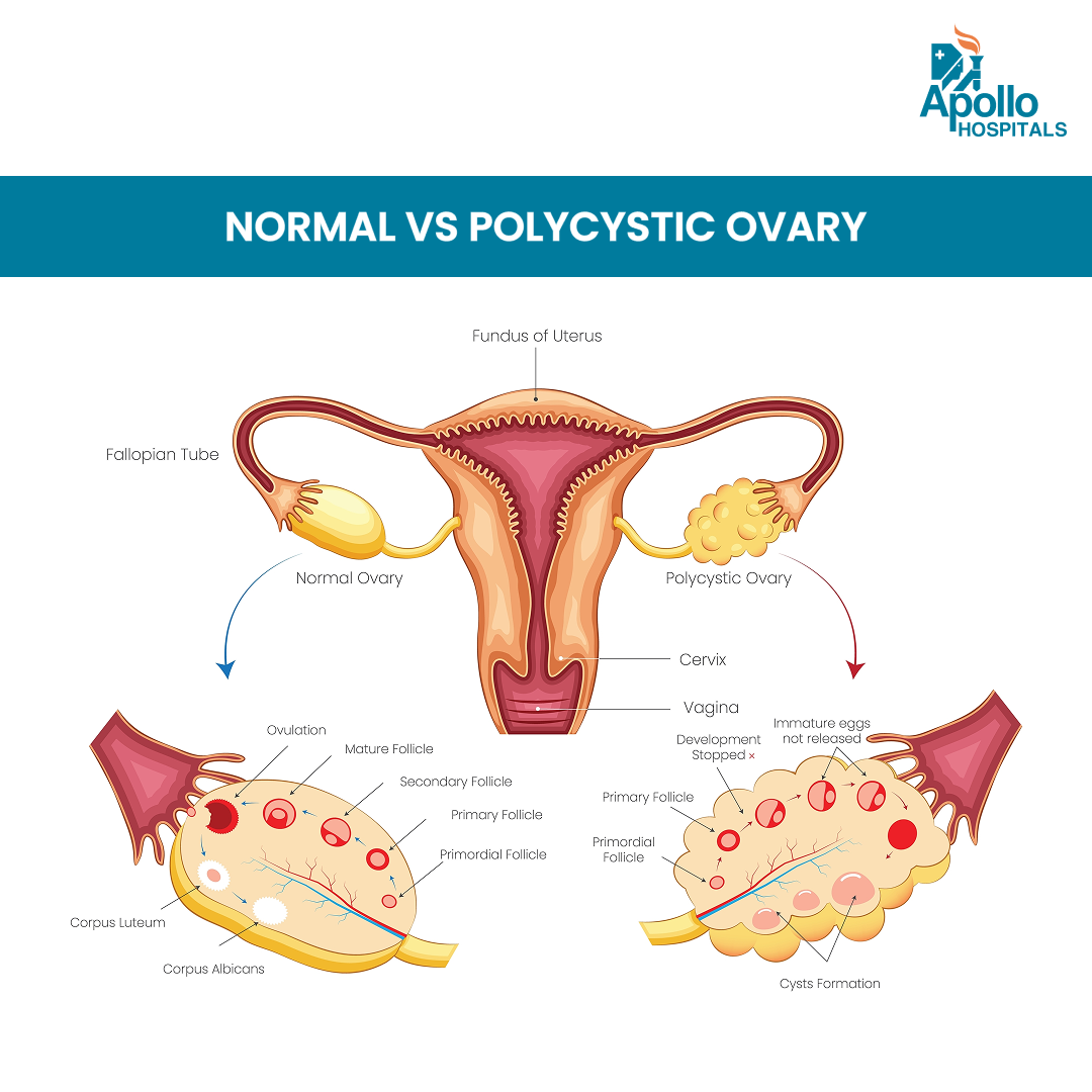 PCOS Is Now PMOS: Doctors Say Name Change Will Improve Diagnosis, Care