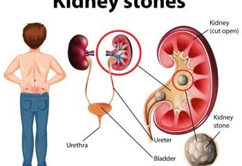 Kidney Stones: why they occur