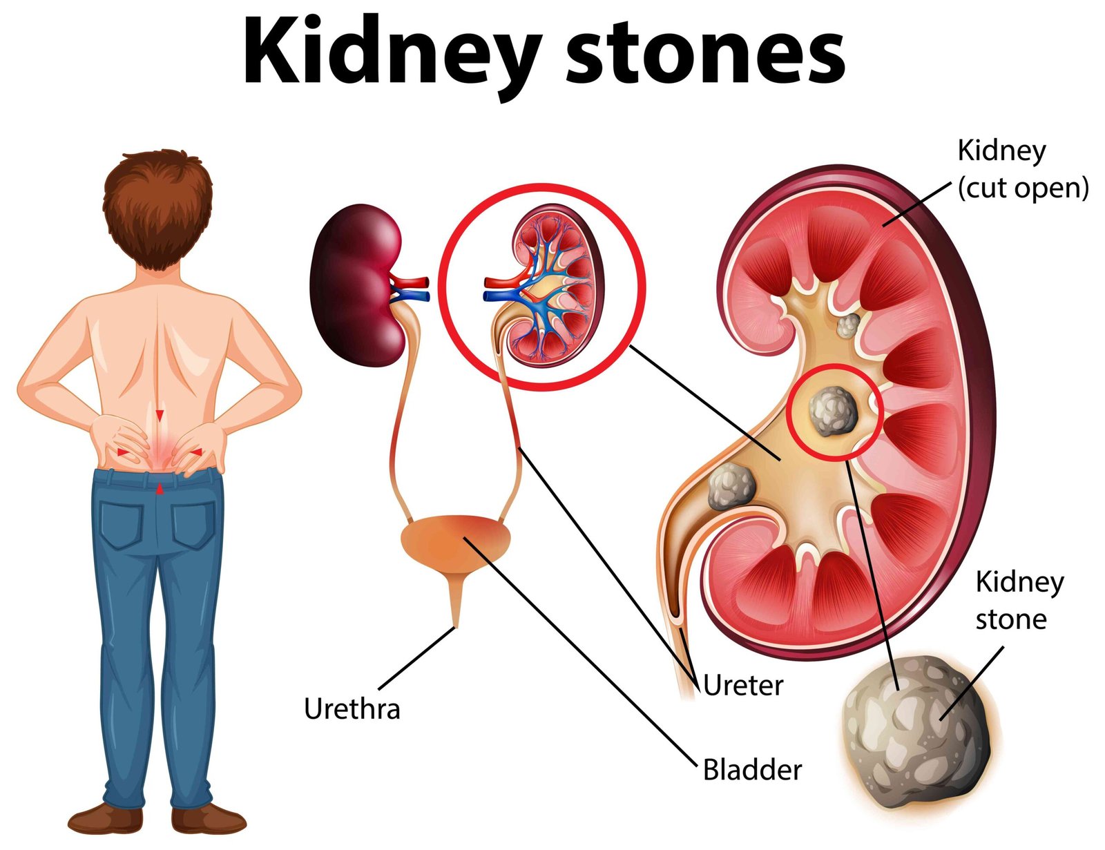 Kidney Stones: why they occur